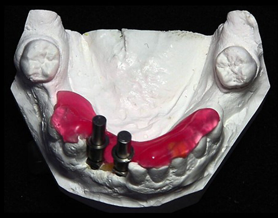 11: Triad gel was placed, completing the corrected Guide Right surgical guide.