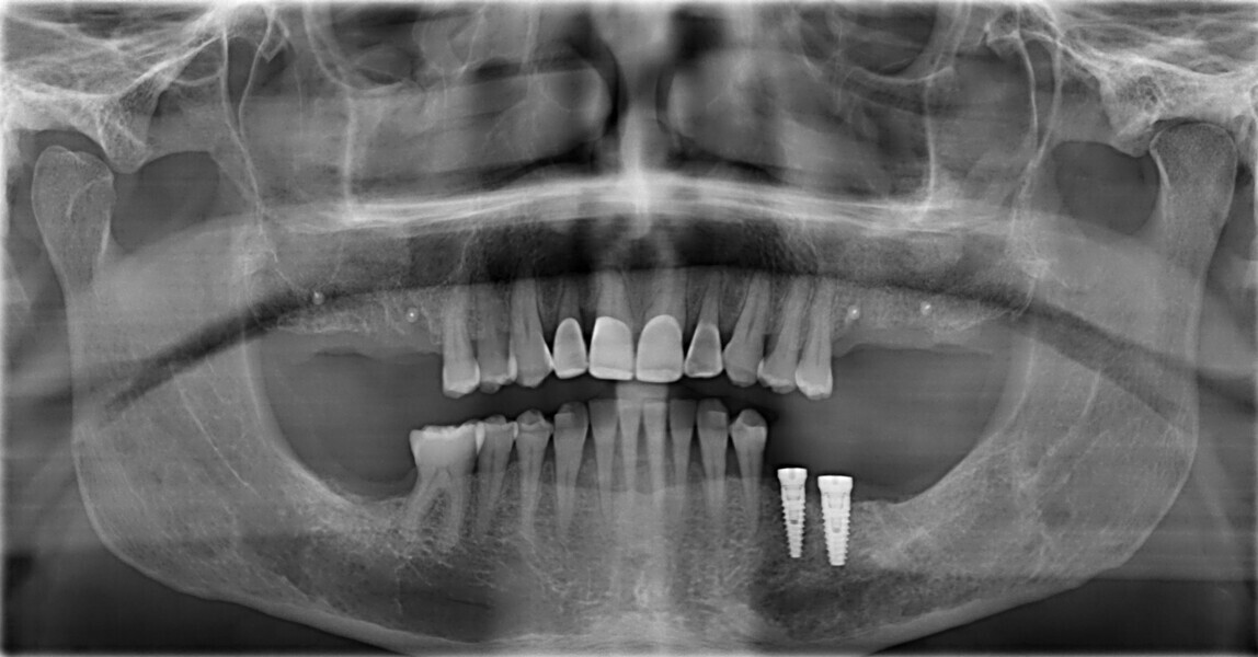 Figs. 22a–c: Dental panoramic tomogram and CBCT scan to confirm the correct positioning of the anterior teeth within the bone at the end of the orthodontic refinement, bone augmentation and placement of implants in positions #45 and 46.