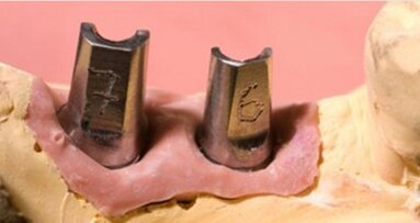 Abrechnung präparierter Implantatpfosten