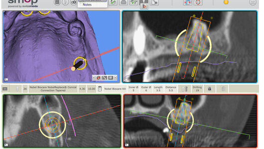 La chirurgie guidée pour optimiser l’implantologie