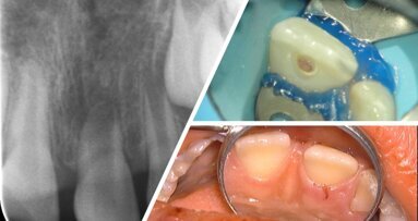 Gezocht voor onderzoek: kinderen met tandschade