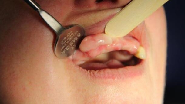 Duże wyrośle kostne szczęki – opis przypadku