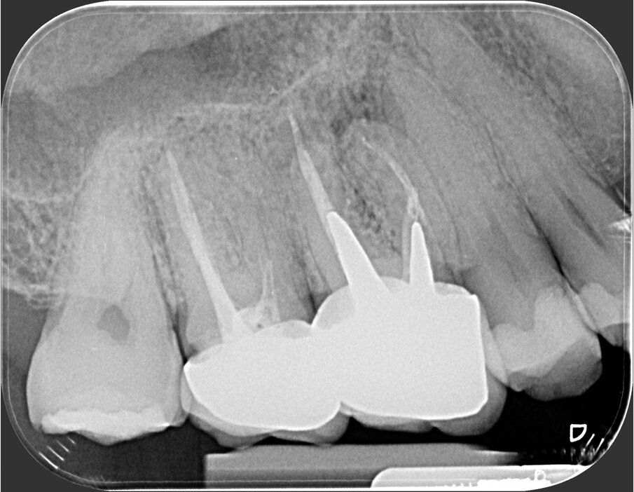 Fig. 1b - Una radiografia presa con diversa angolazione sembra confermare che l’unica radice coinvolta nella lesione periapicale è la mesiovestibolare.