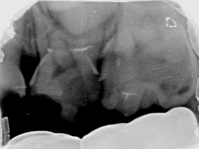Afbeelding 3b: Röntgenfoto's op de leeftijd van 6 jaar, juli 2018.