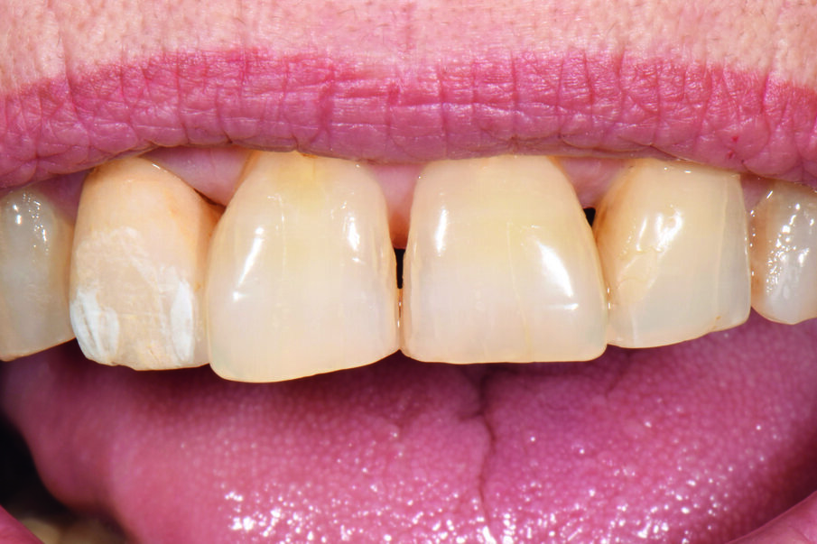 Fig. 4: The play of shade at the incisal edge and the body area was reproduced with VITA AKZENT Plus CHROMA STAINS A and B.