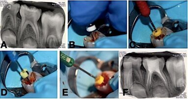 Comparación de pulpectomías en molares temporales con lima manual y reciprocante