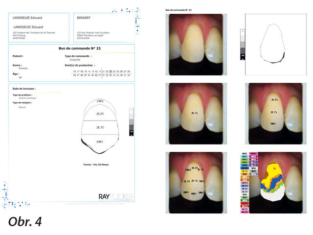 Obr. 4: Zmapování barev kontralaterálního zubu.
