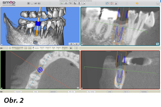 Obr. 2: Virtuální plánování polohy implantátu