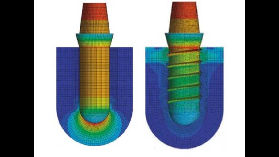 Fig. 11_Von Mises stress per un impianto cilindrico liscio a sinistra e uno filettato a destra.