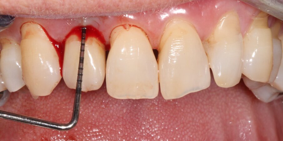 Figg. 6a, 6b - Mucosite perimplantare a carico dell’impianto in sede 12.