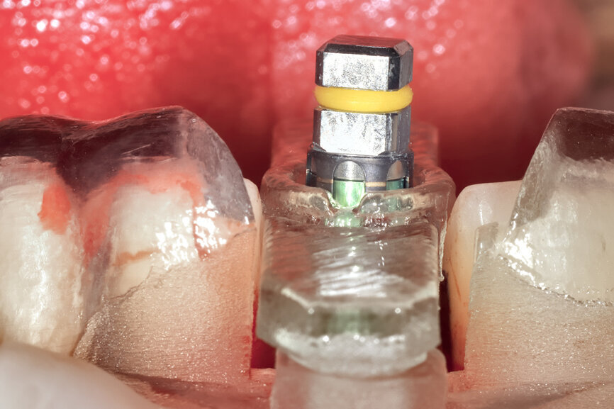 Fig. 24a: Depth control and rotational positioning were accurately
confirmed with the notch indicator on the template corresponding with the insertion tool (a). The occlusal view illustrated that the anti-rotational internal
conical–hexagonal connection was positioned towards the facial aspect (b).