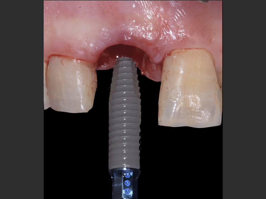Fig. 3 - Straumann BLT Roxolid SLActive RC 4.1 x 14 mm.