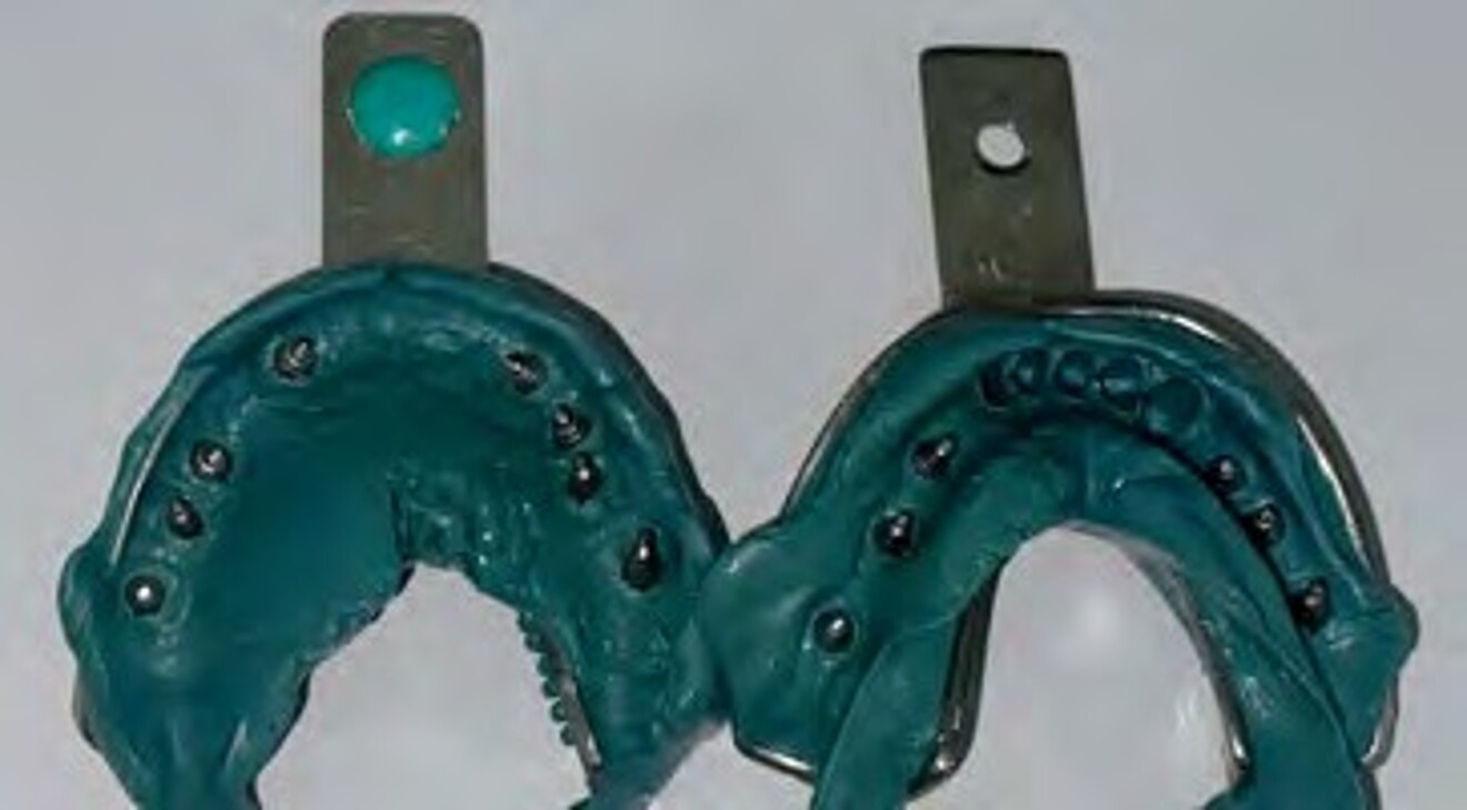Fig. 2h: Definitive implant impressions with impression copings secured in the impression prior to laboratory cast fabrication. 