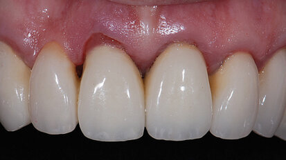 Restoring in the other color: pink