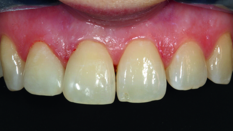 Afbeelding 7. Diasteemsluiting met OMNICHROMA en face.