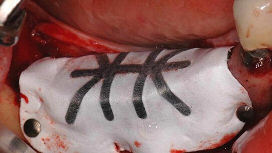 Predicibilità chirurgica della rigenerazione ossea verticale (GBR) nella mandibola posteriore edentula: disegno, gestione e passivazione dei tessuti molli come chiavi principali di successo