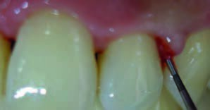 Fig. 1: Checking the attachment and the depth of the pocket