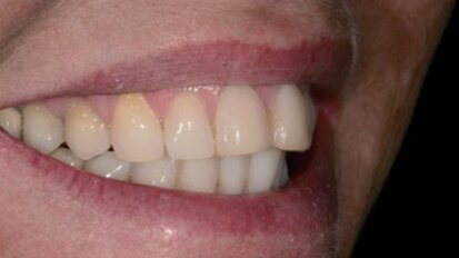 Indirect of direct restaureren: een binaire keuze?