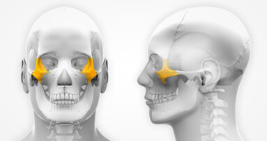 Study introduces new surgical guide for placement of zygomatic implants