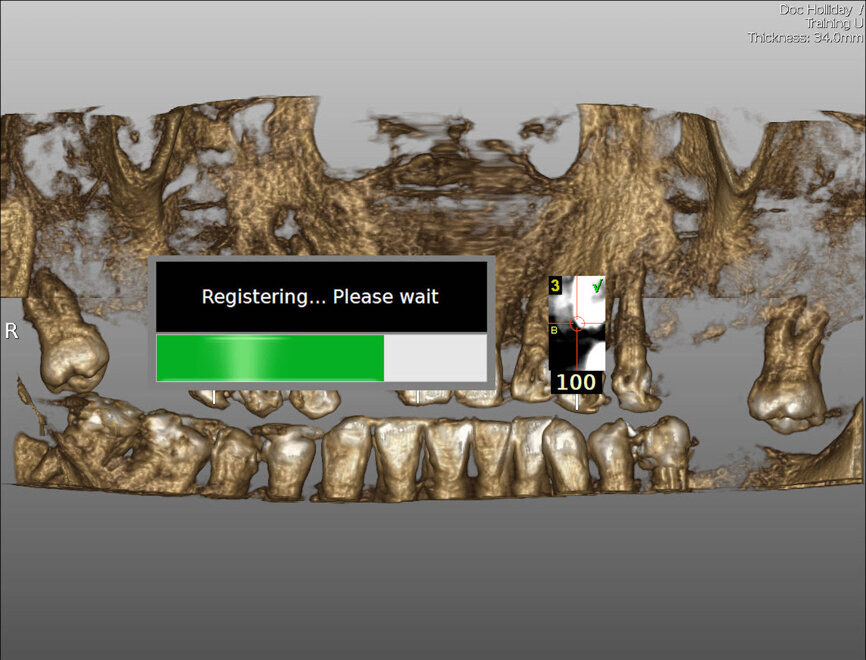 Fig. 7: The Tracer-Tag and the Tracer-Tool are attached, the Tracer-Tool calibrated. The software shows the number of points contacted as a percentage.