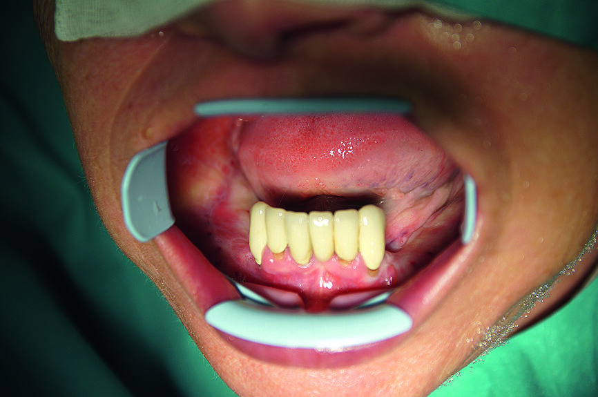 Fig. 6 : Vue préopératoire de la mandibule. 