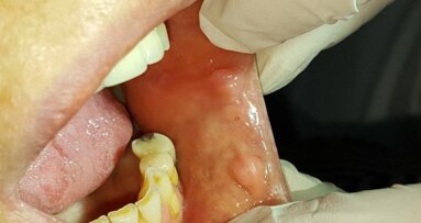 Zastosowanie lasera CO2 w leczeniu zmian na błonie śluzowej – opis przypadków