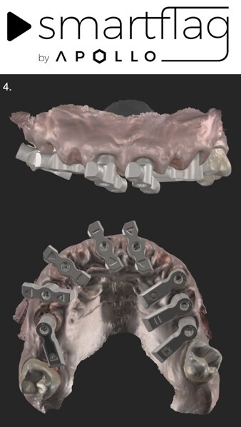 Fig. 27: Scan with SmartFlag scan bodies.