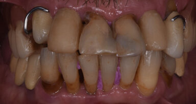 Risoluzione di un caso di parodontite aggressiva con preservazione crestale e chirurgia guidata