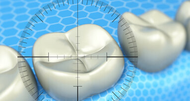 Vormarsch der unbehandelten Karieserkrankungen