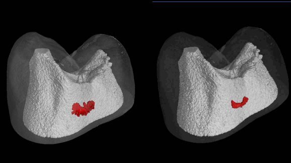 New device to treat caries with electric remineralisation