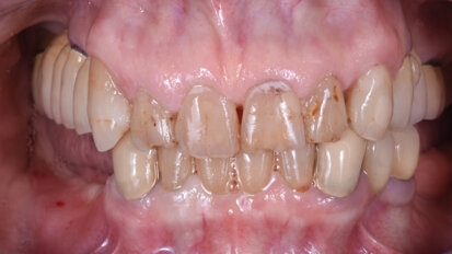 Resolving severe bone atrophy with the cortical lamina technique and innovative materials
