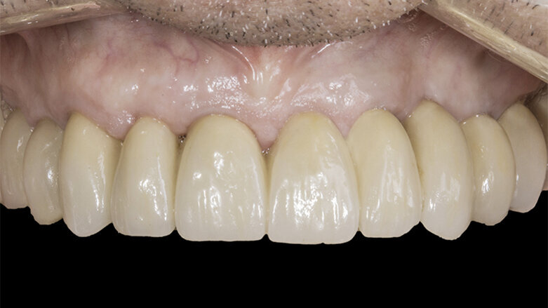 Implant maintenance care solution