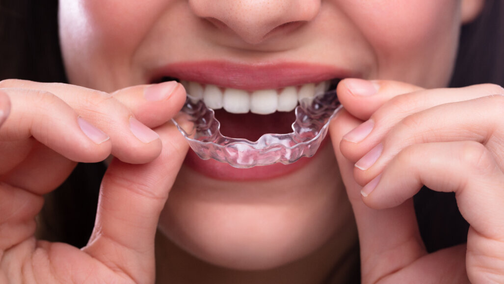 The necessity of multiple aligner attachments—a reality check