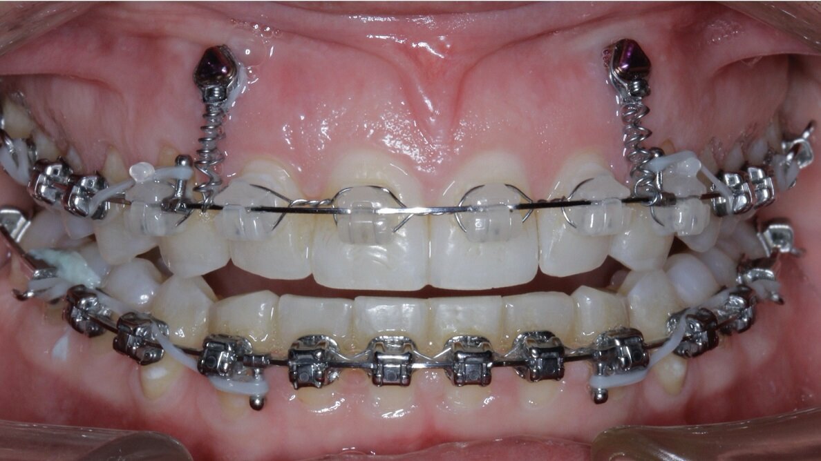 New Age orthodontics and orthopaedics with temporary anchorage devices