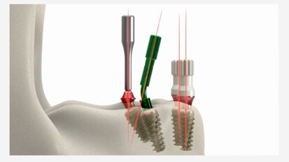 Keystone Dental Group – Conical Connection –  Angle Indicators