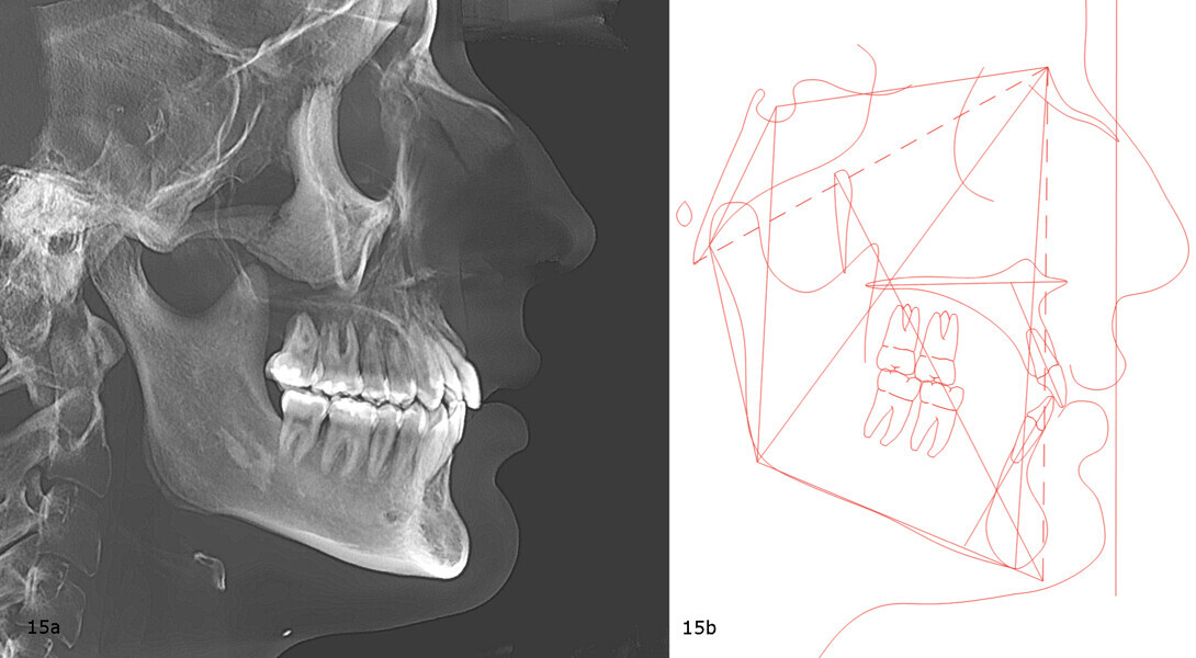 Figs. 15a & b: Post-treatment cephalometric radiograph (a) and tracing (b).