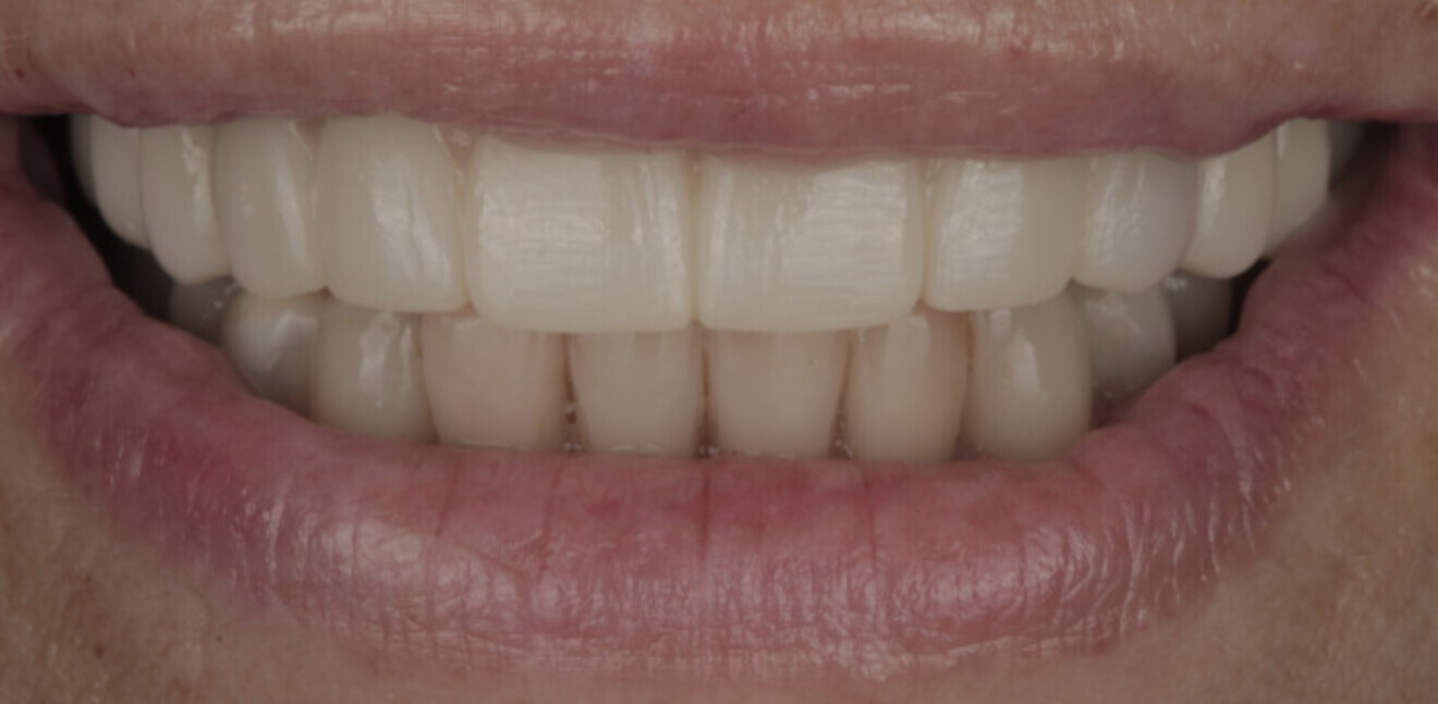 Fig. 21b: Definitive prosthesis. Extra-oral view.