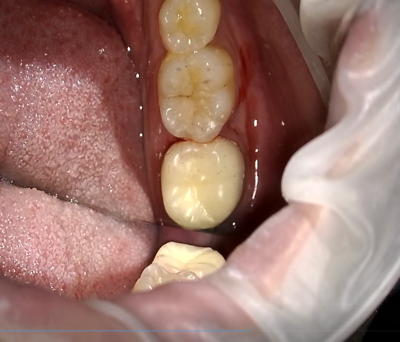 Fig. 12b: Try-in of the provisional crown on tooth #37.