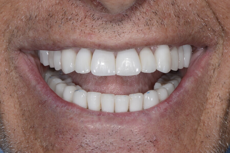 Fig. 27b: Frontal view of the patient’s final smile, mouth open. 