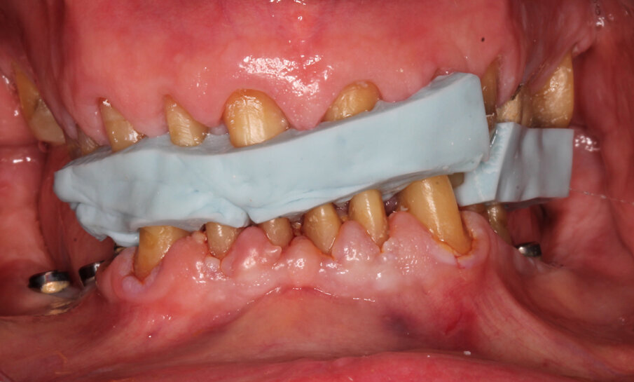 Fig. 16: Transfer of the validated vertical relation using a sequential split mouth procedure