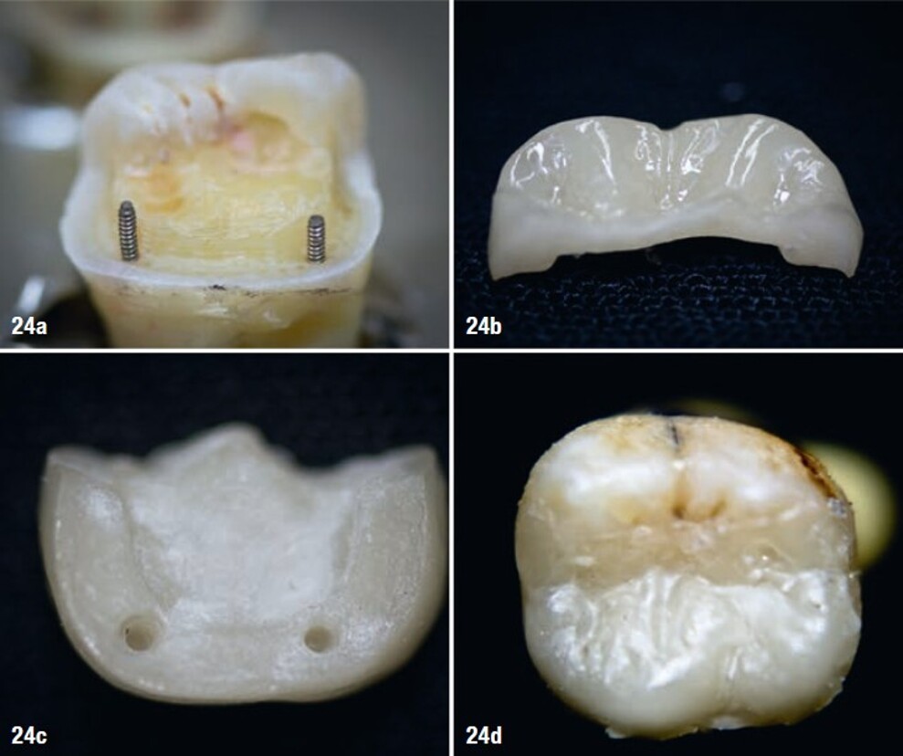 Figs. 24a–d: Previous lithium disilicate pinlay investigation on an extracted tooth: the prepared tooth with two dentine pins (a), the external surface of the lithium disilicate pinlay (b), the internal surface of the pinlay with two pin spaces (c) and the occlusal view of the seated restoration (d).
