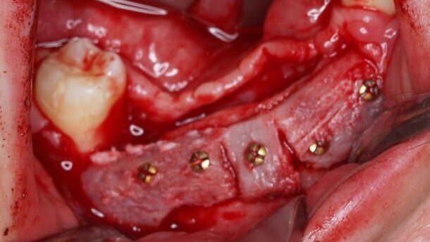 Uraz powybuchowy II stopnia – leczenie złamania żuchwy, rekonstrukcja kości i odbudowa implantologiczna