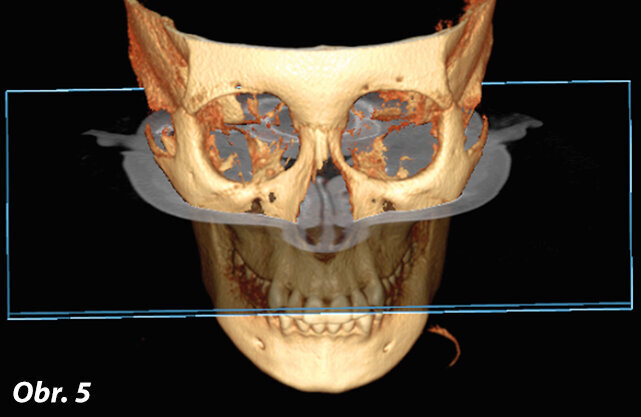 En face pohled na 3D rekonstrukci
