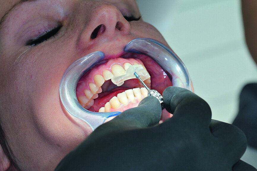Fig. 16: Inserting the abutment with the transfer key.