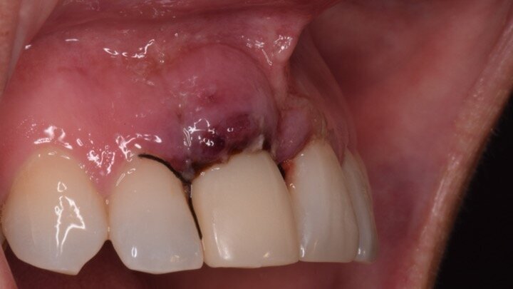 Figura 16. Atornillado directo del diente provisional a 20 Nw. Aprovechamos para llevar el margen de la restauración a la posición correcta en relación con los dientes contiguos y a pesar de la inflamación normal existente. De esta forma, el trabajo ya está realizado, ya que ese diente provisional tiene todas las características del diente definitivo.