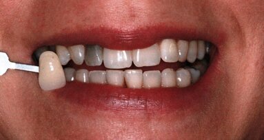 Caso clinico di sbiancamento interno ed esterno