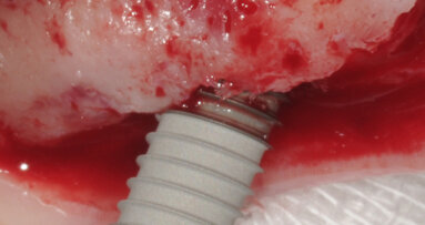 Nuove possibilità per la riabilitazione dei mascellari con estesa pneumatizzazione dei seni mascellari