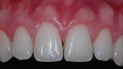 Процедури по удължаване на короните