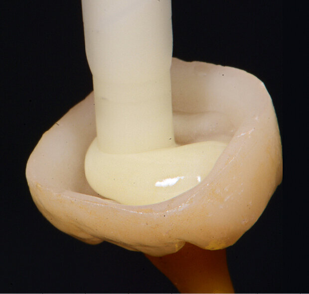 Fig. 7: Applying Variolink Esthetic DC into the crown.