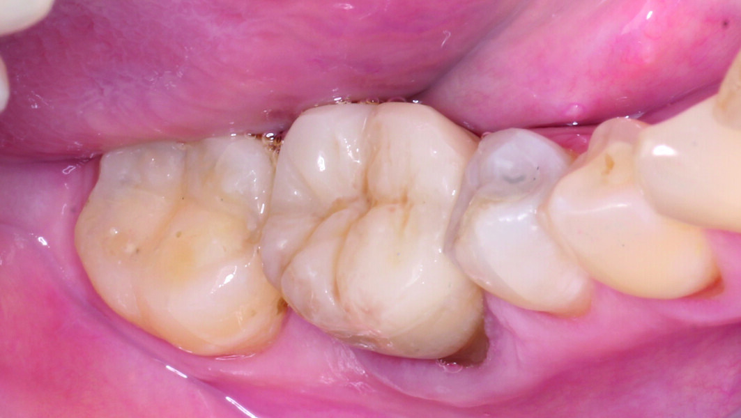 Fig. 16: Astonishing results with excellent marginal adaptation and aesthetics